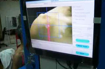 EXCIMER LASER 308